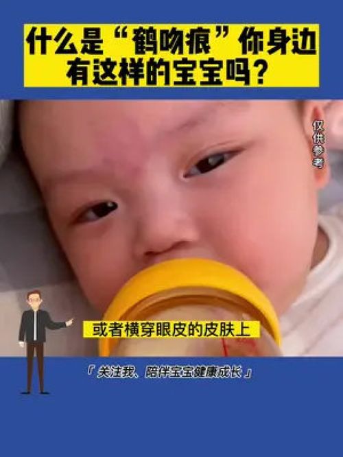 (鹤吻痕的形成原因及位置)鹤吻痕寓意和象征：唤醒传说中的神话力量